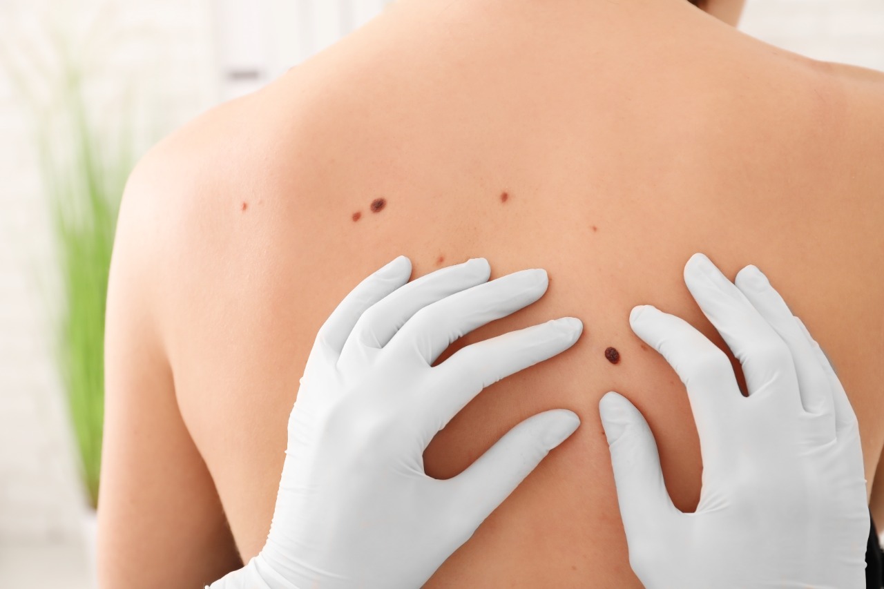 Ilustração da notícia: Dermatologista do HB alerta para cuidados com a Pele durante o Dezembro Laranja